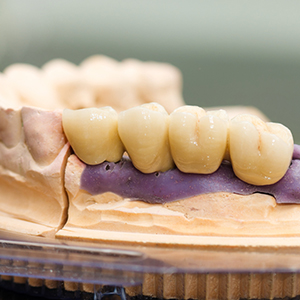 Fixed Dentures in Guntur