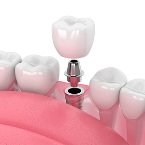 Dental Implants in Guntur